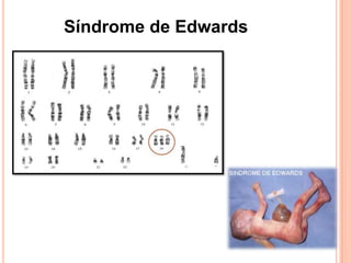 Síndrome de Edwards
