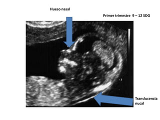 Hueso nasal
Primer trimestre 9 – 12 SDG

Translucencia
nucal

 