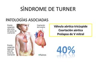 SÌNDROME DE TURNER
PATOLOGÌAS ASOCIADAS
Vàlvula aòrtica tricùspide
Coartaciòn aòrtica
Prolapso de V mitral

 