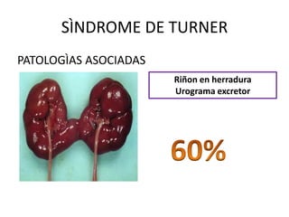 SÌNDROME DE TURNER
PATOLOGÌAS ASOCIADAS
Riñon en herradura
Urograma excretor

 
