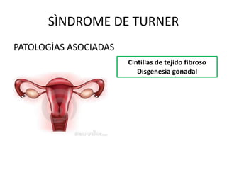 SÌNDROME DE TURNER
PATOLOGÌAS ASOCIADAS
Cintillas de tejido fibroso
Disgenesia gonadal

 