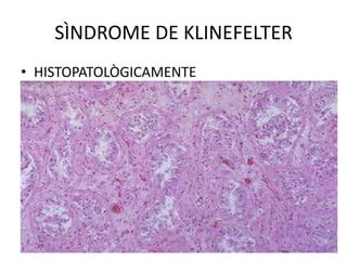 SÌNDROME DE KLINEFELTER
• HISTOPATOLÒGICAMENTE

 