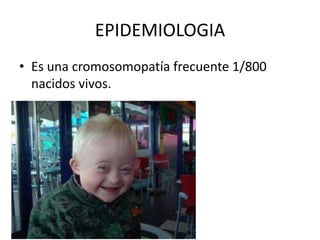 EPIDEMIOLOGIA
• Es una cromosomopatía frecuente 1/800
nacidos vivos.

 