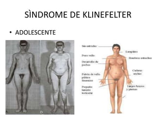 SÌNDROME DE KLINEFELTER
• ADOLESCENTE

 