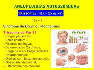 ANEUPLOIDIAS AUTOSSÔMICAS
TRISSOMIA – 45A + XX ou XY
Síndrome de Down ou Mongolismo
Trissomia do Par 21:
- Pregas palpebrais;
- Baixa estatura;
- Fissúras na língua;
- Deformidades Cardíacas;
- Prega na mão- Prega simiesca;
- Retardo mental;
- Orelhas com baixa implantação;
- Obesidade abdominal;
- Esterilidade nas meninas.
2n + 1
 