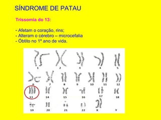 SÍNDROME DE PATAU
Trissomia do 13:
- Afetam o coração, rins;
- Alteram o cérebro – microcefalia
- Óbtito no 1º ano de vida.
 