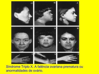 Síndrome Triplo X. A falência ovariana prematura ou
anormalidades de ovário.
 