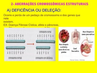 2- ABERRAÇÕES CROMOSSÔMICAS ESTRUTURAIS
A) DEFICÊNCIA OU DELEÇÃO:
Ocorre e perda de um pedaço de cromossomo e dos genes que
nele
existem.
EX: Doença Fibrose Cística, afeta o pâncreas.
Câncer renal – cromossomo nº 11
 