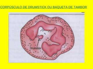 CORPÚSCULO DE DRUMSTICK OU BAQUETA DE TAMBOR
 