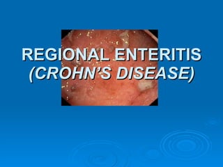 REGIONAL ENTERITIS  (CROHN’S DISEASE) 