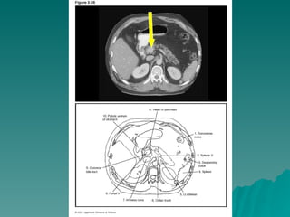 Cross Sectional Anatomy Of The Abdomen Annotated | PPT