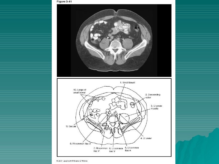 Cross Sectional Anatomy Of The Abdomen Annotated