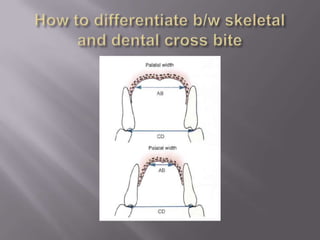 Cross bite | PPTX
