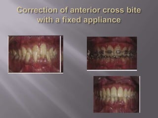 Cross bite | PPTX
