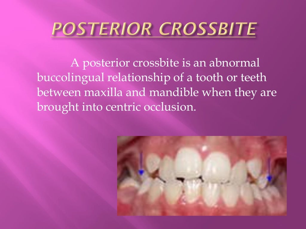 MalocclusionCross bite