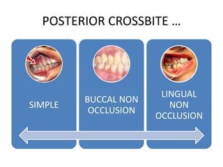 Cross Bitree Crossbite | PPTX