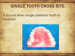 Crossbite in orthodontics,its types and management with two cases | PPTX