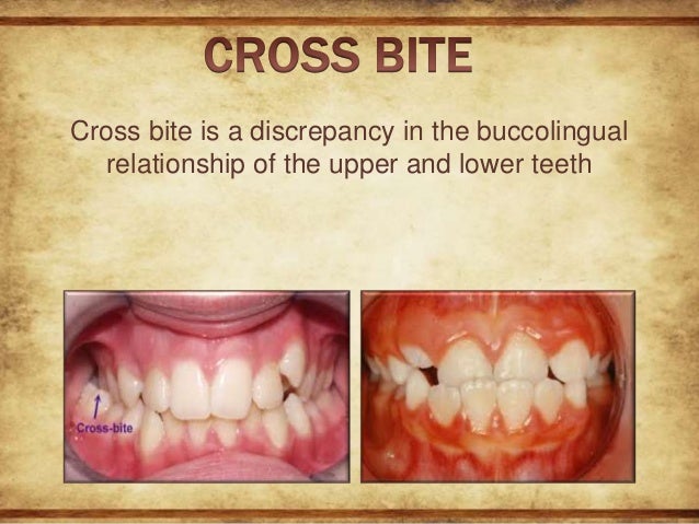 crossbite in orthodontics its types and management with two cases crossbite