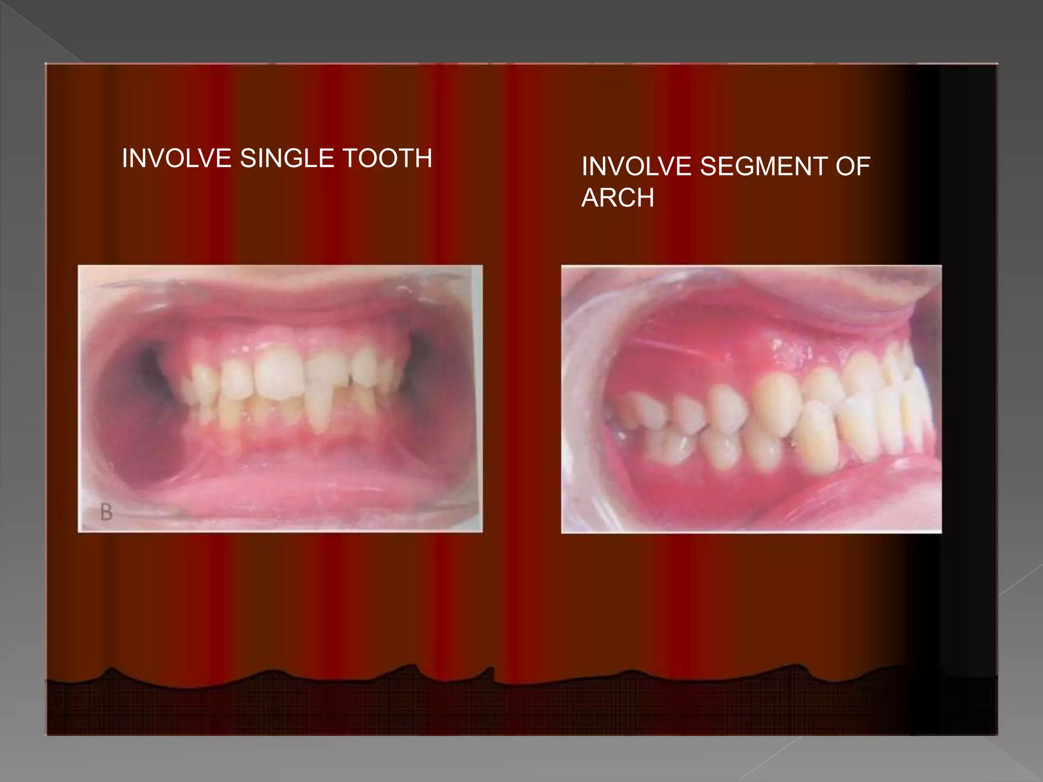 INVOLVE SINGLE TOOTH INVOLVE SEGMENT OF
ARCH
 