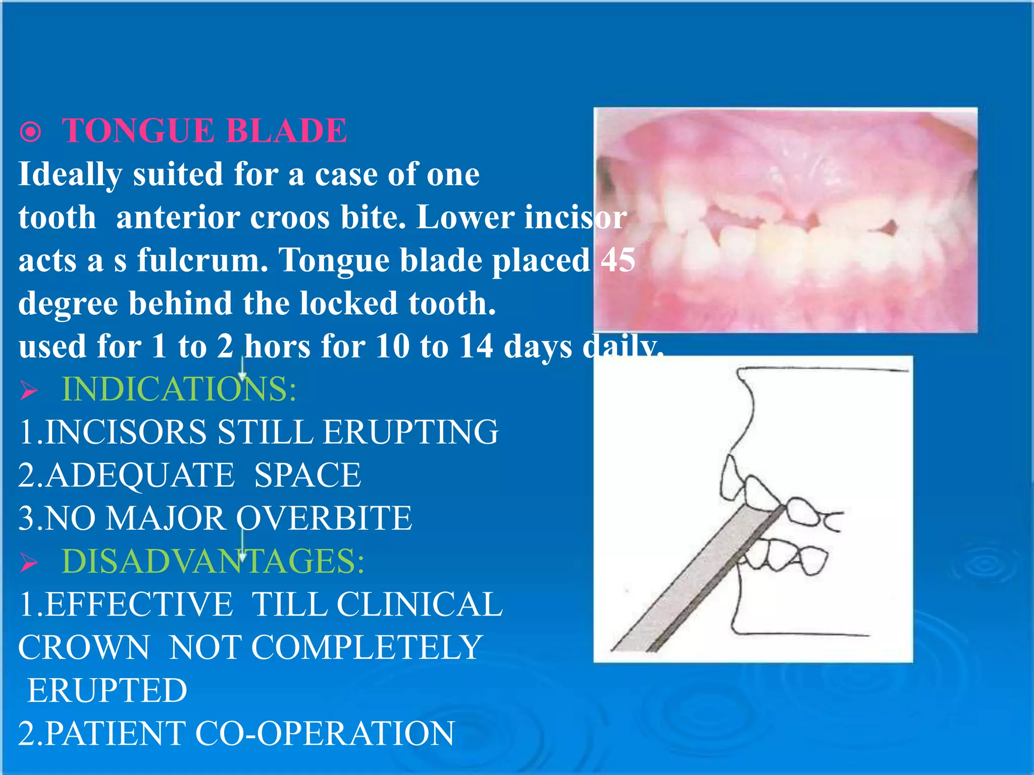  TONGUE BLADE
Ideally suited for a case of one
tooth anterior croos bite. Lower incisor
acts a s fulcrum. Tongue blade placed 45
degree behind the locked tooth.
used for 1 to 2 hors for 10 to 14 days daily.
 INDICATIONS:
1.INCISORS STILL ERUPTING
2.ADEQUATE SPACE
3.NO MAJOR OVERBITE
 DISADVANTAGES:
1.EFFECTIVE TILL CLINICAL
CROWN NOT COMPLETELY
ERUPTED
2.PATIENT CO-OPERATION
 