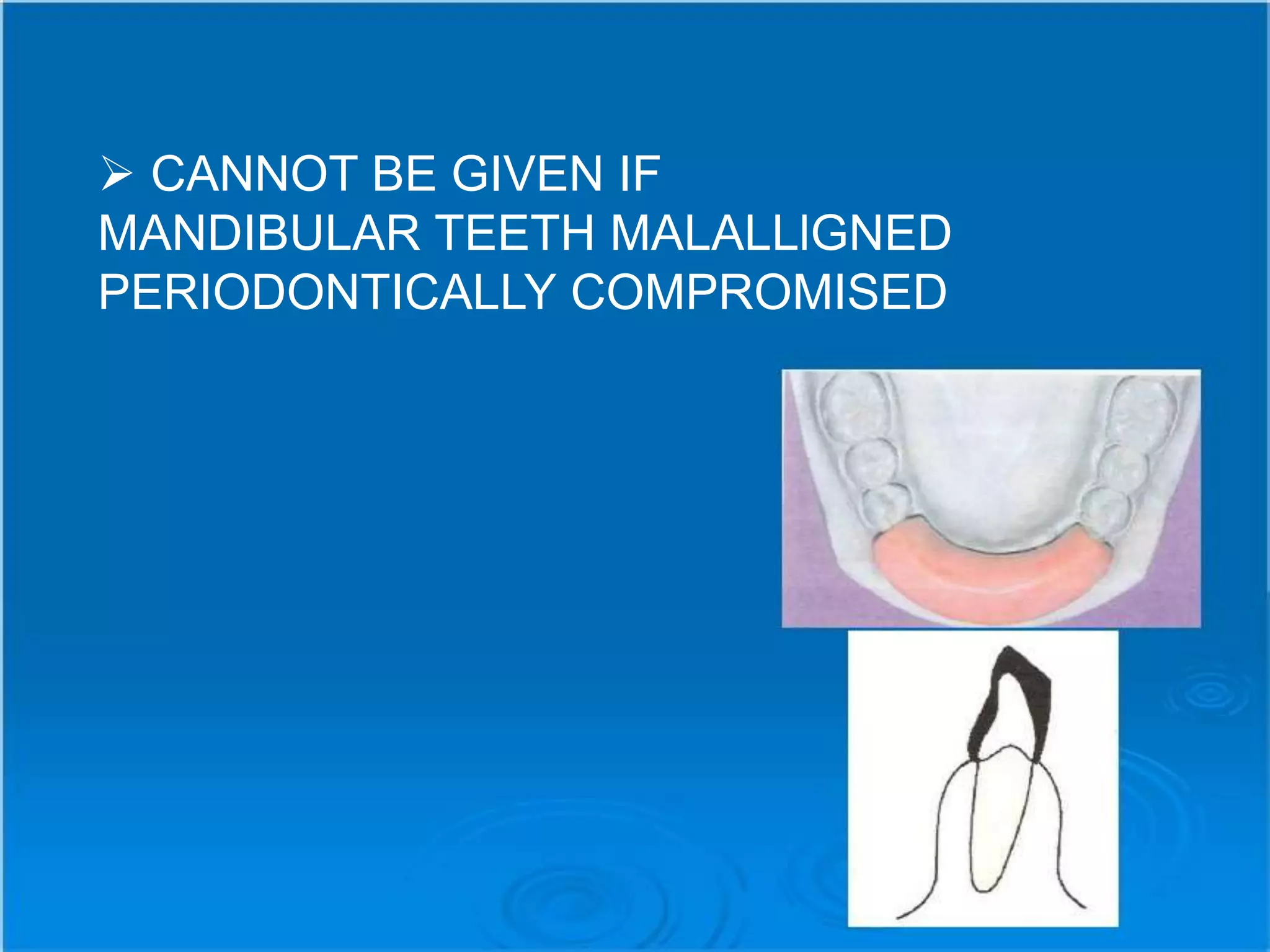  CANNOT BE GIVEN IF
MANDIBULAR TEETH MALALLlGNED
PERIODONTICALLY COMPROMISED
 