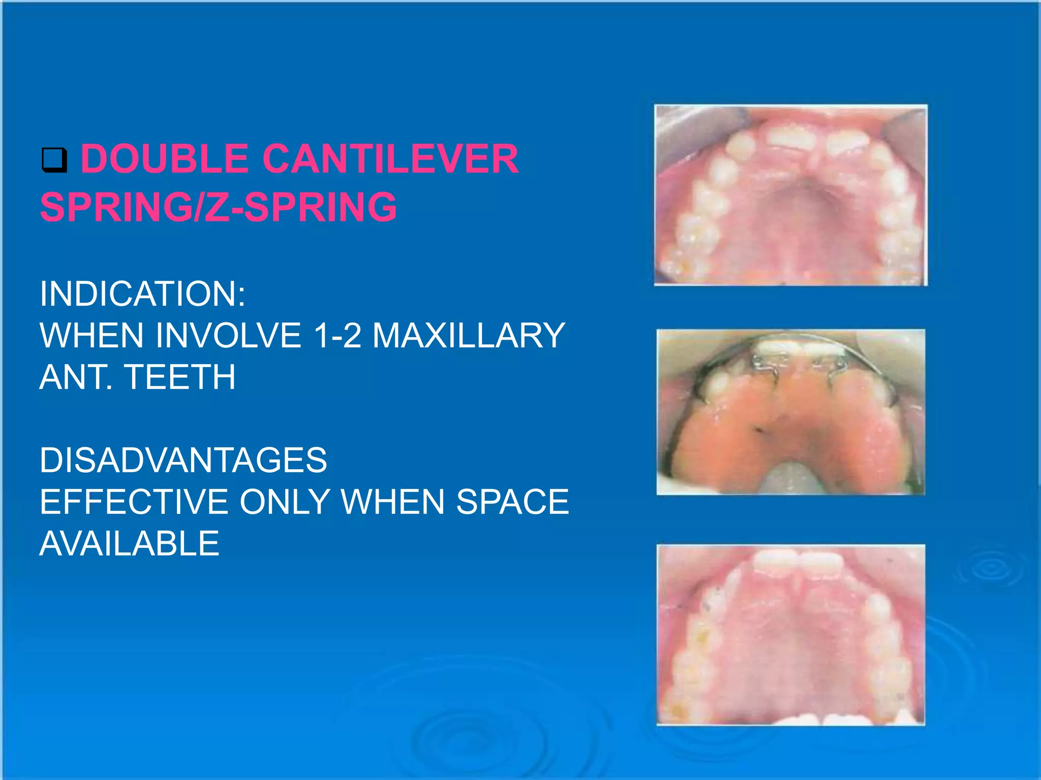  DOUBLE CANTILEVER
SPRING/Z-SPRING
INDICATION:
WHEN INVOLVE 1-2 MAXILLARY
ANT. TEETH
DISADVANTAGES
EFFECTIVE ONLY WHEN SPACE
AVAILABLE
 