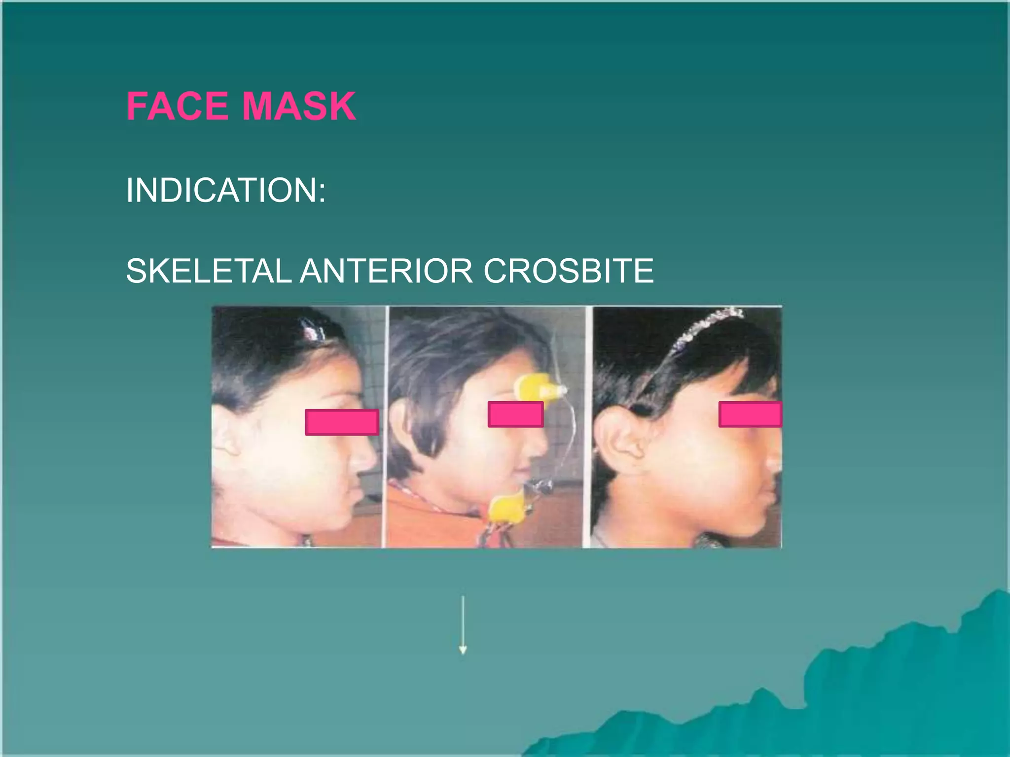 FACE MASK
INDICATION:
SKELETAL ANTERIOR CROSBITE
 