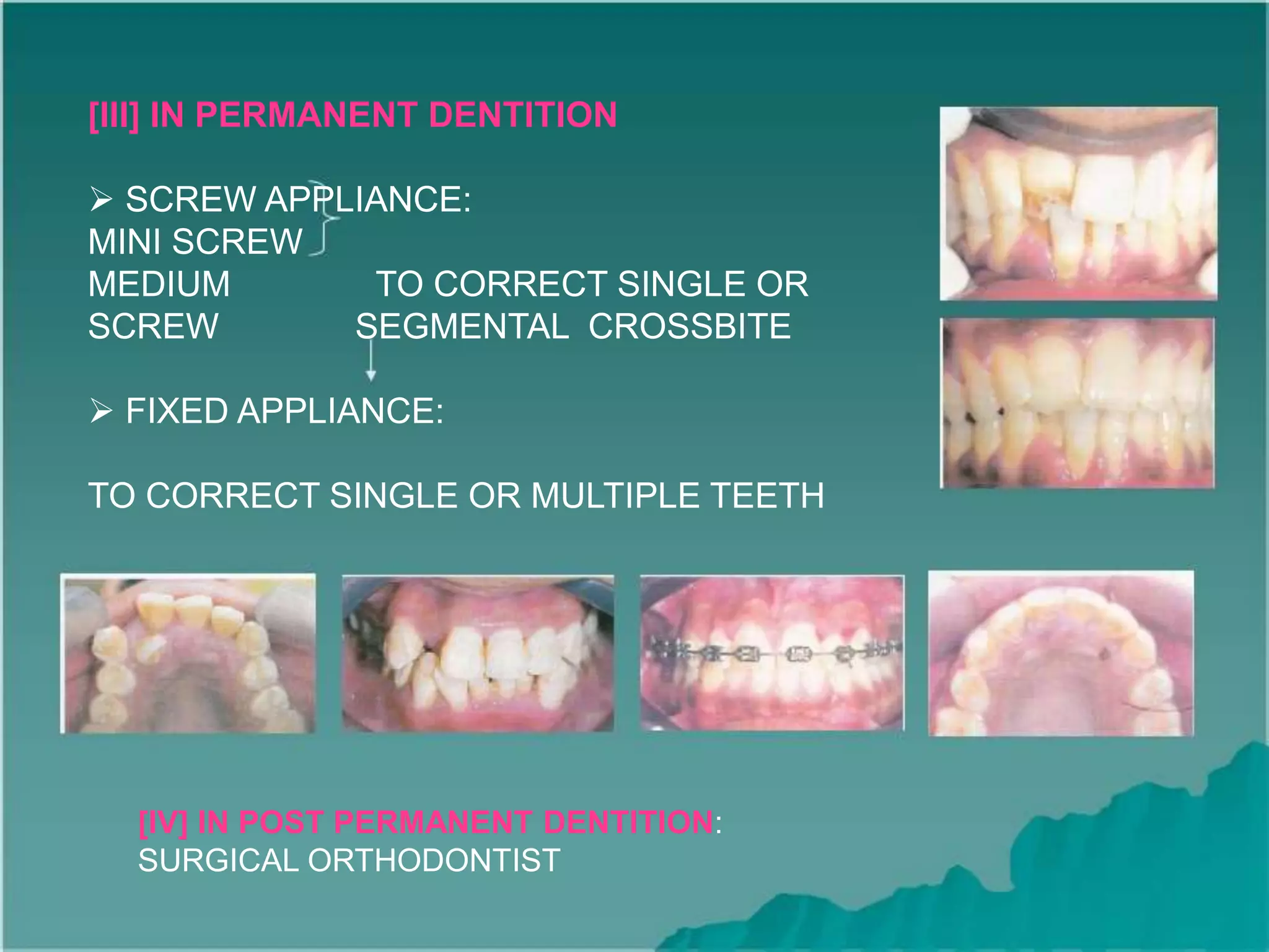 [III] IN PERMANENT DENTITION
 SCREW APPLIANCE:
MINI SCREW
MEDIUM TO CORRECT SINGLE OR
SCREW SEGMENTAL CROSSBITE
 FIXED APPLIANCE:
TO CORRECT SINGLE OR MULTIPLE TEETH
[IV] IN POST PERMANENT DENTITION:
SURGICAL ORTHODONTIST
 