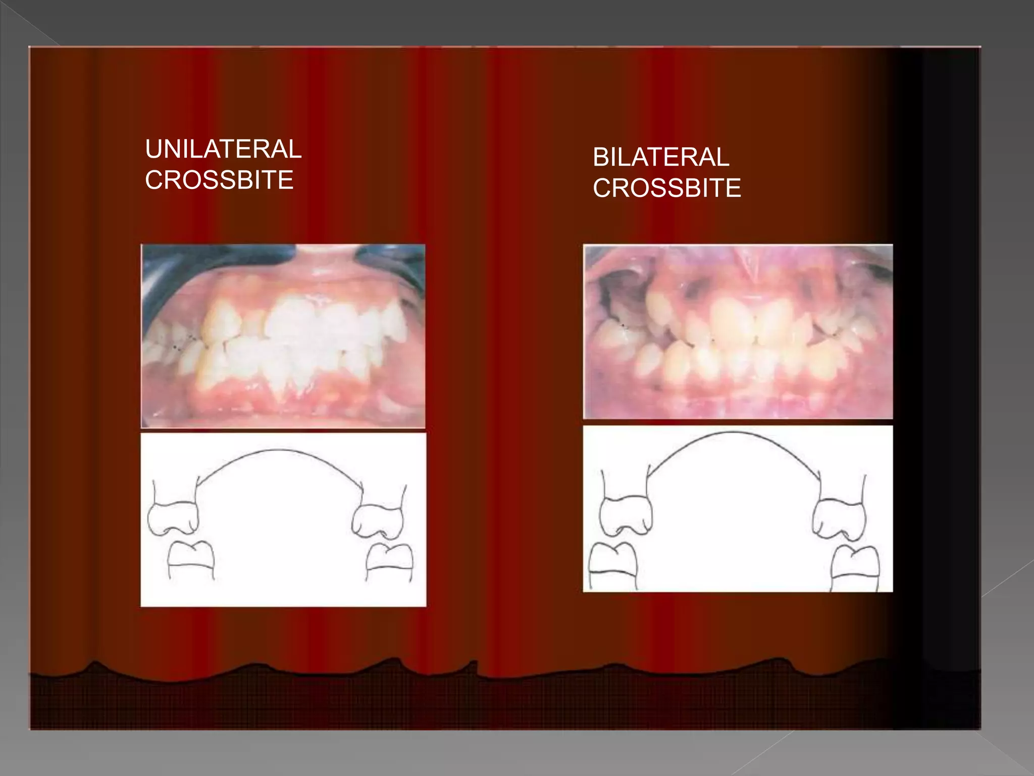 UNILATERAL
CROSSBITE
BILATERAL
CROSSBITE
 