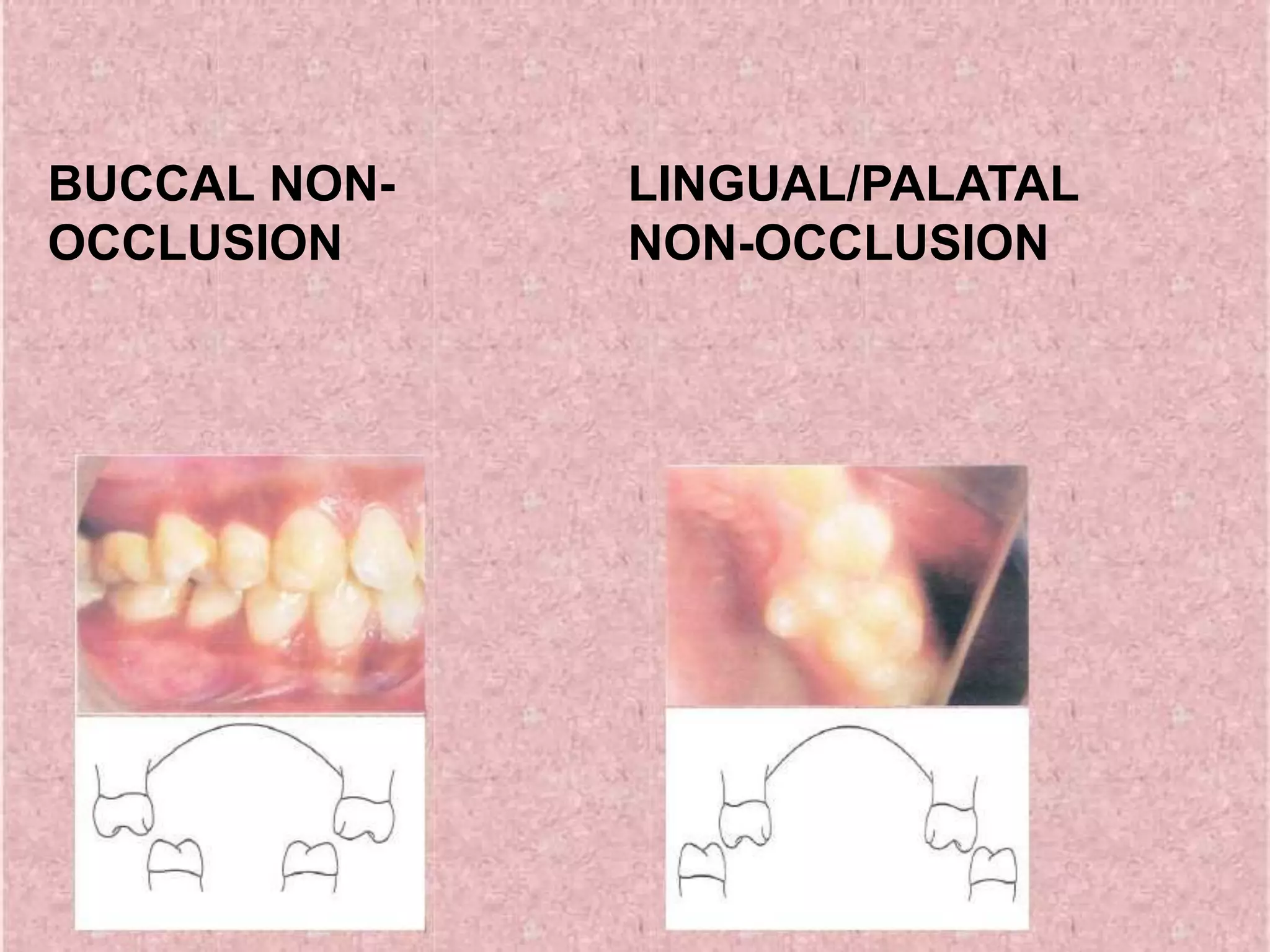 BUCCAL NON-
OCCLUSION
LINGUAL/PALATAL
NON-OCCLUSION
 