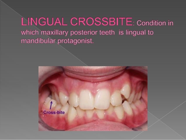 crossbite crossbite