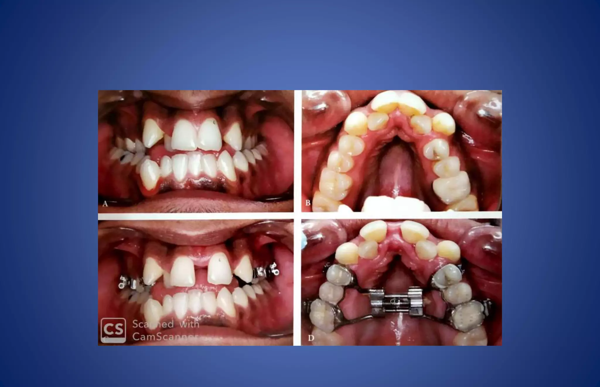 Crossbite | PPTX