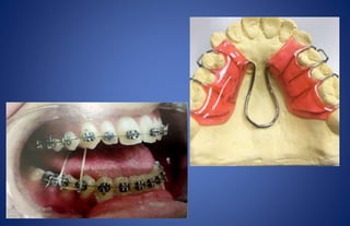 Crossbite | PPTX