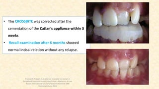 • The CROSSBITE was corrected after the
cementation of the Catlan’s appliance within 3
weeks
• Recall examination after 6 months showed
normal incisal relation without any relapse.
Prashanth Prakash et.al Anterior Crossbite Correction in
EarlyMixed Dentition Period Using Catlan’s Appliance: A Case
Report.International Scholarly Research Network ISRN
Dentistry,Volume 2011
 