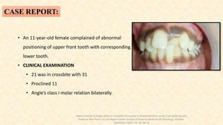 CASE REPORT:
• An 11-year-old female complained of abnormal
positioning of upper front tooth with corresponding
lower tooth.
• CLINICAL EXAMINATION
• 21 was in crossbite with 31
• Proclined 11
• Angle’s class I molar relation bilaterally.
Ankita Sinhaet.al Single Anterior Crossbite Correction in Mixed Dentition Using Z’spring Along with
Posterior Bite Plane: A Case Report Indian Journal of Forensic Medicine & Toxicology, October-
December 2020, Vol. 14, No. 4
 