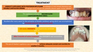 The use of Hawley’s appliance was continued to achieve adequate overjet and overbite for
another 2 months.
After 3 months of active treatment, the CROSSBITE was successfully
corrected.
6th week, CROSSBITE was found to be corrected
with 21.
Recalled after every week for the activation of double cantilever spring which was accomplished
by OPENING EACH OF TWO HELICES 2MM.
This appliance is known to DELIVER SLOW-
LIGHTCONTINUOUS FORCE.
“HAWLEY’S APPLIANCE WITH POSTERIOR BITE PLANE to achieve a 2 mm incisal clearance and
DOUBLE CANTILEVER SPRING (23 gauge wire) to push the palatally placed upper incisor labially”.
TREATMENT
Ankita Sinhaet.al Single Anterior Crossbite Correction in Mixed Dentition Using Z’spring Along with Posterior Bite Plane:
A Case Report Indian Journal of Forensic Medicine & Toxicology, October-December 2020, Vol. 14, No. 4
 