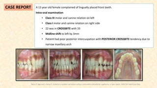 A 13 year old female complained of lingually placed front teeth.
Intra-oral examination
• Class III molar and canine relation on left
• Class I molar and canine relation on right side
• 22 was in CROSSBITE with 33
• Midline shift to left by 3mm
• Patient had poor posterior intercuspation with POSTERIOR CROSSBITE tendency due to
narrow maxillary arch
CASE REPORT
Batra P, Agarwal I, Katyal S. Anterior crossbite correction using a removable orthodontic appliance: a case report. MOJ Clin Med Case Rep.
 