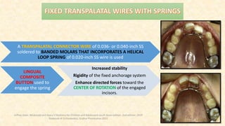 A TRANSPALATAL CONNECTOR WIRE of 0.036- or 0.040-inch SS
soldered to BANDED MOLARS THAT INCORPORATES A HELICAL
LOOP SPRING of 0.020-inch SS wire is used
LINGUAL
COMPOSITE
BUTTON used to
engage the spring
Increased stability
Rigidity of the fixed anchorage system
Enhance directed forces toward the
CENTER OF ROTATION of the engaged
incisors.
Jeffrey Dean. Mcdonald and Avery’s Dentistry for Children and Adolescent south Asian edition. 2nd edition. 2019
Textbook of Orthodontics, Sridhar Premkumar:2015
 