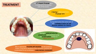 A “U” shaped 19 gauge wire
is soldered to the palatal
side of the bands.
Z-Spring is fabricated from
23 gauge wire.
During fabrication the active arm of
this Z-SPRING IS KEPT AT THE
BUCCAL SURFACE OF TOOTH.
Spring is soldered onto the
palatal arch and stabilized using
an acrylic button similar to
NANCE BUTTON.
Bite is opened by PLACING BITE BLOCKS on the posterior
molars using Resin Modified Glass Ionomer Cements (GC
Corporation) so as to achieve a 2 MM INCISAL CLEARANCE.
TREATMENT
 