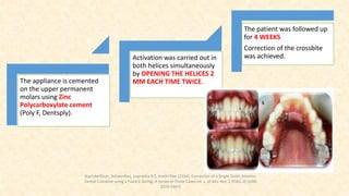 The appliance is cemented
on the upper permanent
molars using Zinc
Polycarboxylate cement
(Poly F, Dentsply).
Activation was carried out in
both helices simultaneously
by OPENING THE HELICES 2
MM EACH TIME TWICE.
The patient was followed up
for 4 WEEKS
Correction of the crossbite
was achieved.
NachiketShah, AshwinRao, Suprabha B.S, Arathi Rao (2014); Correction of a Single Tooth Anterior
Dental Crossbite using a Fixed Z-Spring: A Series of Three Cases Int. J. of Adv. Res. 2 (Feb). 0] (ISSN
2320-5407)
 