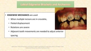 • EDGEWISE MECHANICS are used
• When multiple incisors are in crossbite,
• Palatal displacement
• Rotations are severe
• Adjacent tooth movements are needed to adjust anterior
spacing.
Jeffrey Dean. Mcdonald and Avery’s Dentistry for Children and Adolescent south Asian edition. 2nd edition. 2019
Textbook of Orthodontics, Sridhar Premkumar:2015
 