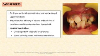 • An 8-year-old female complained of improperly aligned
upper front teeth.
• The patient had a history of abscess and early loss of
deciduous maxillary anteriors about 2 years back.
• Intraoral examination
• Crowding in both upper and lower arches.
• 21 was palatally placed and in crossbite relation
CASE REPORTS
Sunil M M, Zareena M A, Ratheesh M S, Anjana G. Early orthodontic interception of anterior crossbite in mixed dentition. J
Int Oral Health 2017;9:88-90
 