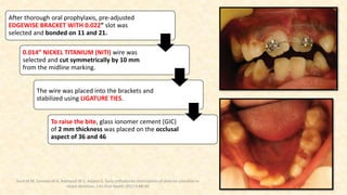 After thorough oral prophylaxis, pre-adjusted
EDGEWISE BRACKET WITH 0.022” slot was
selected and bonded on 11 and 21.
0.014” NICKEL TITANIUM (NITI) wire was
selected and cut symmetrically by 10 mm
from the midline marking.
The wire was placed into the brackets and
stabilized using LIGATURE TIES.
To raise the bite, glass ionomer cement (GIC)
of 2 mm thickness was placed on the occlusal
aspect of 36 and 46
Sunil M M, Zareena M A, Ratheesh M S, Anjana G. Early orthodontic interception of anterior crossbite in
mixed dentition. J Int Oral Health 2017;9:88-90
 