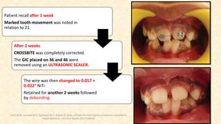 Patient recall after 1 week
Marked tooth movement was noted in
relation to 21.
After 2 weeks
CROSSBITE was completely corrected.
The GIC placed on 36 and 46 were
removed using an ULTRASONIC SCALER.
The wire was then changed to 0.017 ×
0.022” NiTi
Retained for another 2 weeks followed
by debonding.
Sunil M M, Zareena M A, Ratheesh M S, Anjana G. Early orthodontic interception of anterior crossbite in
mixed dentition. J Int Oral Health 2017;9:88-90
 
