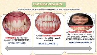 Discrepancy is a localized
problem in TOOTH ERUPTION
(DENTAL CROSSBITE)
A gross BASAL DISHARMONY
between the MAXILLA AND
MANDIBLE
(SKELETAL CROSSBITE)
A TRANSVERSE DISCREPANCY in
the upper to lower arch width
that produces a LATERAL SHIFT
OF THE MANDIBLE ON CLOSURE
(FUNCTIONAL CROSSBITE).
Before treatment, the type of posterior CROSSBITES in children must be determined
 