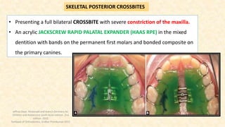 • Presenting a full bilateral CROSSBITE with severe constriction of the maxilla.
• An acrylic JACKSCREW RAPID PALATAL EXPANDER (HAAS RPE) in the mixed
dentition with bands on the permanent first molars and bonded composite on
the primary canines.
SKELETAL POSTERIOR CROSSBITES
Jeffrey Dean. Mcdonald and Avery’s Dentistry for
Children and Adolescent south Asian edition. 2nd
edition. 2019
Textbook of Orthodontics, Sridhar Premkumar:2015
 