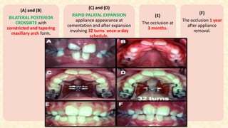 (A) and (B)
BILATERAL POSTERIOR
CROSSBITE with
constricted and tapering
maxillary arch form.
(C) and (D)
RAPID PALATAL EXPANSION
appliance appearance at
cementation and after expansion
involving 32 turns once-a-day
schedule.
(E)
The occlusion at
3 months.
(F)
The occlusion 1 year
after appliance
removal.
 