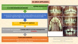 W-ARCH APPLIANCE.
2 years post-treatment
Transverse posterior widths are in proper relationship with no mandibular
shift evident during closure.
The crossbite was corrected in 6 weeks with 2- to 3-mm overexpansion; the
appliance was left in place for 3 months.
Soldered W-lingual arch appliance at
cementation.
In rest to first contact position, the dental midlines are normal with the
posterior segments edge-to-edge bilaterally in transverse width.
Crossbite extends through buccal segment from the LATERAL INCISOR WITH
A 2.5-MM MANDIBULAR MIDLINE shift to the affected side.
Jeffrey Dean. Mcdonald and Avery’s Dentistry for
Children and Adolescent south Asian edition. 2nd
edition. 2019
Textbook of Orthodontics, Sridhar Premkumar:2015
 