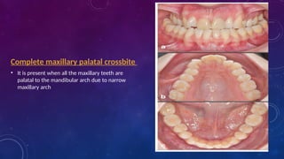 crossbite orthodontics final yearl bds.pptx
