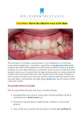 Crossbites: Know the effective ways to fix them
The prevalence of crossbites among humans is very unfortunate as it can lead to
severe dental complexities. A crossbite is caused due to misalignment in the teeth,
leading to the teeth coming together, but either inside or totally outside of its proper
positions. It is also often referred to as a 'bad bite' as the two rows of teeth don't meet
properly. In the case of a normal bite, the upper teeth generally sit a little towards the
outside of the lower teeth at the front, sides and the back of the mouth. Usually, the
most common crossbite occurs when the top back teeth are inside the lowers on just
one side. Hence, when the bite isn't right, proper dental care must be taken to fix the
teeth at the earliest.
The possible effects of Crossbite
The several problems that may arise from a crossbite includes:
 misaligned bites may result in various types of dental problems, health &
emotional issues, dental anxiety, etc.
 Tooth decay and gum disease might become a definitive, if not treated
properly.
 stress on the jaws can lead to the prevalence of chronic jaw problems &
 
